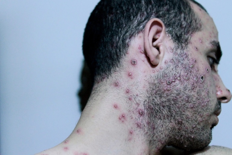 الاشتباه في 3 حالات لجذري القرود بالمغرب.. هل ستصبح كل الأمراض "كورونا" جديدة؟