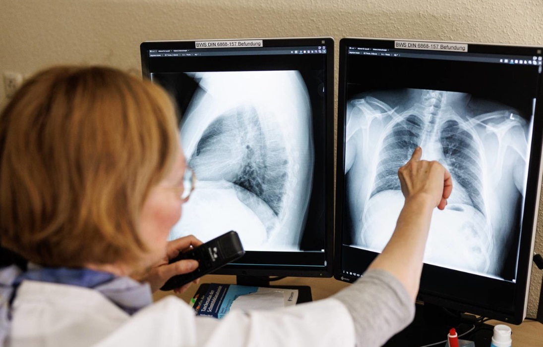  خوارزمية ذكية تساعد على اكتشاف سرطان الرئة 