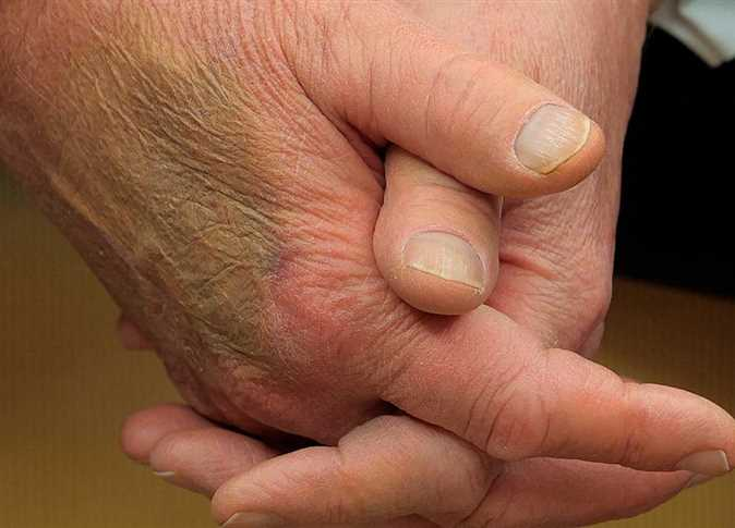 السر وراء الكدمة الكبيرة في كفّ ترامب !