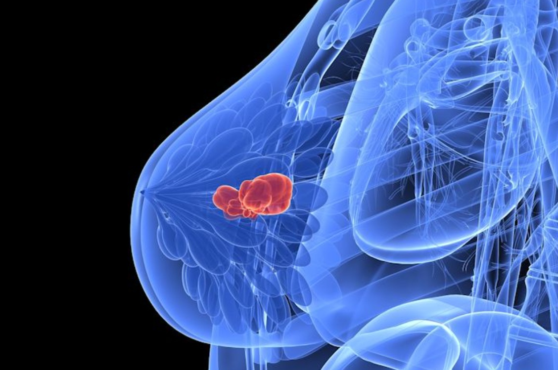 دراسة أمريكية تكشف عن علاج واعد لسرطان الثدي الثلاثي السلبي باستخدام تقنية كريسبر